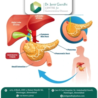 Ahmedabad, Health, Best Pancreas Surgeon In Ahmedabad, India For Minimally Invasive Options