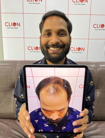 Ahmedabad, Health, Hair Transplant In Surat Gujarat | Best Hair Clinic &ndash; Clion Care