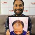Hair Transplant In Surat Gujarat | Best Hair Clinic &ndash; Clion Care