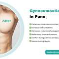 Gynecomastia Surgery In Pune