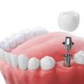 Why Choose Dental Implants For Missing Teeth?