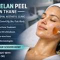Best Acnelan Peel In Thane At DNA Royal | Professional Acne Control Treatment