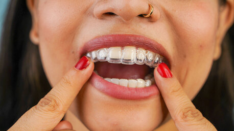Noida, Dental, Clear Aligners In Noida