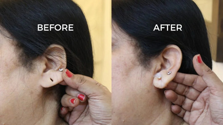 Chennai, Business, Restore Confidence With Professional Earlobe Correction