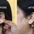 Restore Confidence With Professional Earlobe Correction