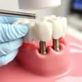 USD 299,  Dental Implant Therapy: A Long-Lasting Solution For Missing Teeth