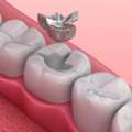Dental Teeth Filling Treatment / Dentist Gangapur Road, Nashik