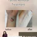 Tattoo Removal Treatment In Vizag