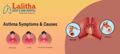 Karimnagar, Health, Asthma Explained: Types, Symptoms, Causes & Management Tips