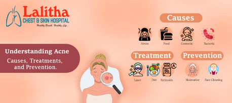 Karimnagar, Health, Understanding Acne: Causes, Treatments & Prevention Tips