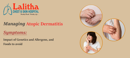 Karimnagar, Health, Managing Atopic Dermatitis: Causes, Genetics & Foods To Avoid