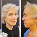 Schedule Facelift Surgery Consultation With Certified Surgeons