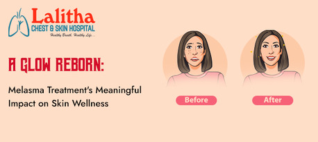 Karimnagar, Health, Effective Melasma Treatment | Hello Radiant Skin