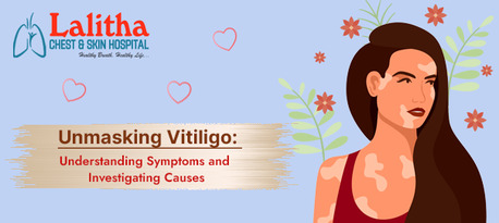 Karimnagar, Health, Unmasking Vitiligo: Symptoms, Causes & Treatment Options