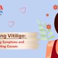 Unmasking Vitiligo: Symptoms, Causes & Treatment Options