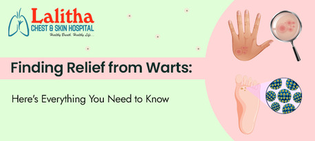 Karimnagar, Health, Wart Relief Guide: Treatments, Causes & Prevention Tips
