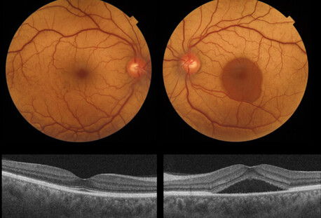 Mumbai, Health, Everything You Need To Know About CSR (Central Serous Retinopathy)