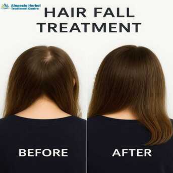 Noida, Health, Hair Loss Treatment In Noida &ndash; Herbal Hair Care Experts