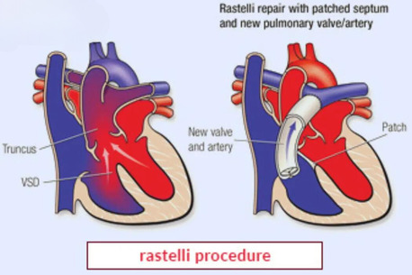 Mumbai, Health, Rastelli Procedure