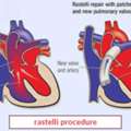 Rastelli Procedure