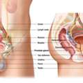 Enlarged Prostate Treatment Hospital In India