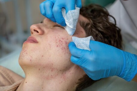 London, Medical, Acne Treatment Options Explained By A Consultant Dermatologist In London