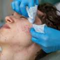Acne Treatment Options Explained By A Consultant Dermatologist In London