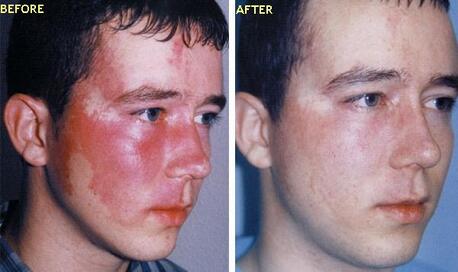 Sydney, Beautician, Port Wine Birthmark Laser Therapy &mdash; Results You&rsquo;ll See