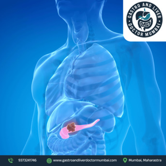 Mumbai, Health, Advanced Pancreatic Cancer Treatment In Mumbai With Expert Care