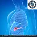 Advanced Pancreatic Cancer Treatment In Mumbai With Expert Care