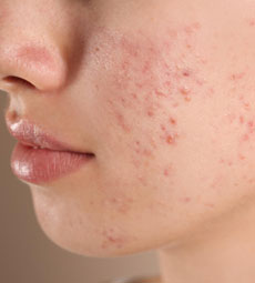 New Delhi, Health, Best Skin Treatment Gaur City