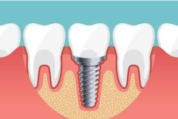 Gurgaon, Health, Best Dental Implants Clinic In Gurgaon