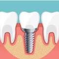 Best Dental Implants Clinic In Gurgaon