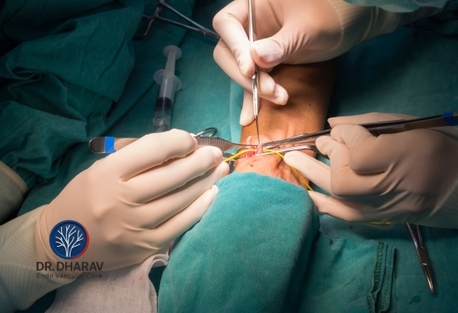 Mumbai, Health, Specialized AV Fistula Treatment In India With Expert Care By Dr.Dharav Kheradia