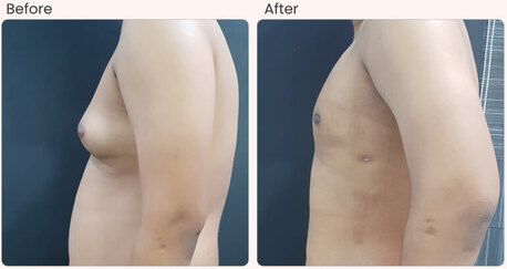 Mumbai, Health, Common Side Effects And Risks Of Gynecomastia Surgery