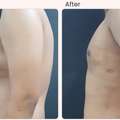 Common Side Effects And Risks Of Gynecomastia Surgery