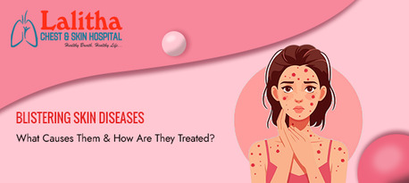 Karimnagar, Health, Blistering Skin Diseases: Causes, Symptoms, And Treatments