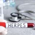 Herpes Simplex Treatment In Telangana