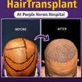 Best Hair Transplant Surgeon In Jaipur