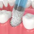 Transform Your Smile With Expert Bone Grafting In Caldwell