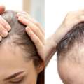 Advanced Hair Transplant Solutions In Thane At DNA Royal Clinic