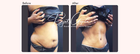Mumbai, Health, Latest Tummy Tuck Surgery Techniques Available Today