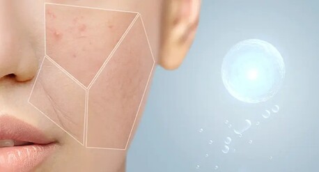 Dubai, Beautician, Acne Treatment In Dubai: Clear, Healthy Skin With Expert Care