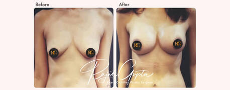 Mumbai, Health, Breast Augmentation Surgery Financing Options In India