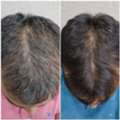 Hair Fall Treatment In Thane At DNA Royal Aesthetic Clinic | Advanced Solutions For Strong