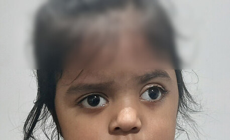 Mumbai, Health, Squint Eye Surgery In Delhi - Dr Anisha Gupta