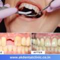 Advanced & Affordable Dentist In Vile Parle East | AK Dental Clinic