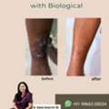 Psoriasis Treatment With Biologics &ndash; Real Results, Real Relief