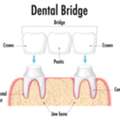 Crown & Bridges For Strong, Natural-Looking, And Long-Lasting Smiles