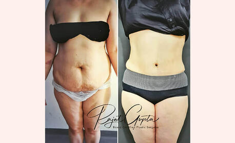 Mumbai, Health, Virtual Consultations For Tummy Tuck Surgery: What You Need To Know